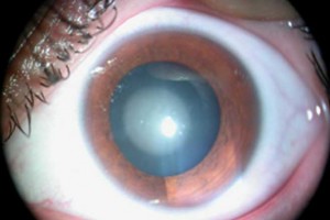 Симптомы болезни и причины катаракты у детей