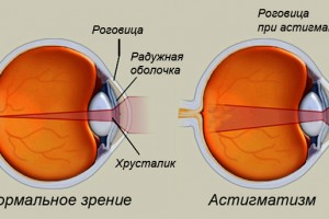 Коррекция зрения при астигматизме